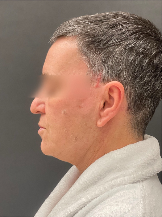 Face liposuction