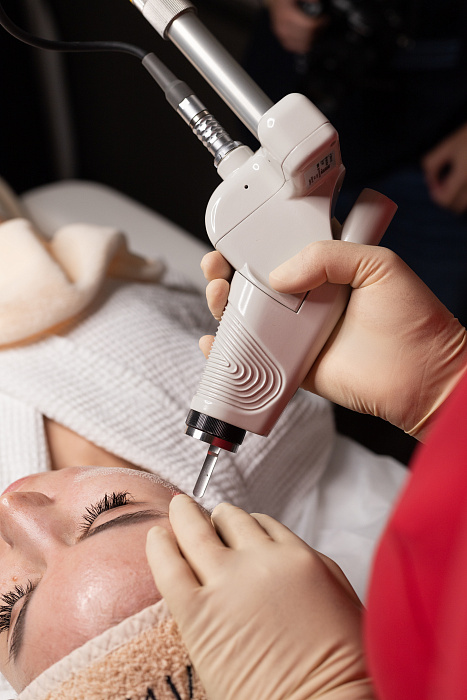 CO2 Laser Grinding procedure in Moscow