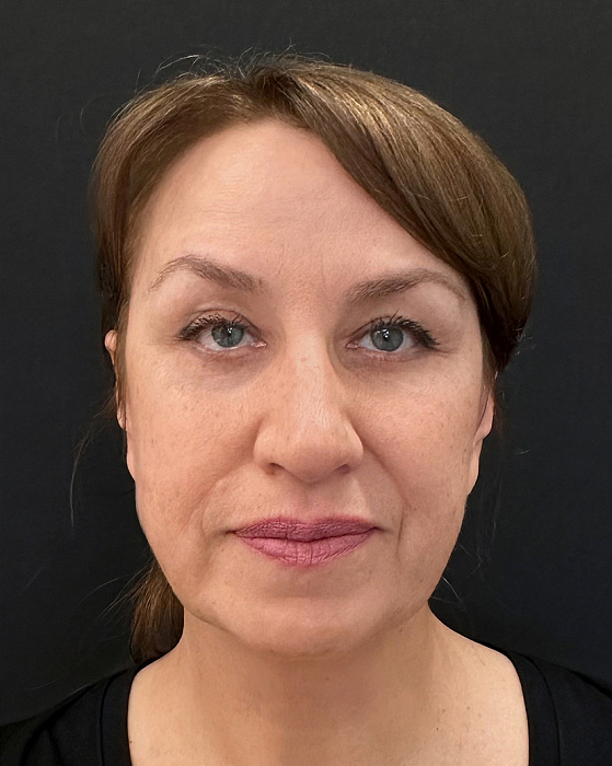 Endoscopic facelift, Blefaroplasty