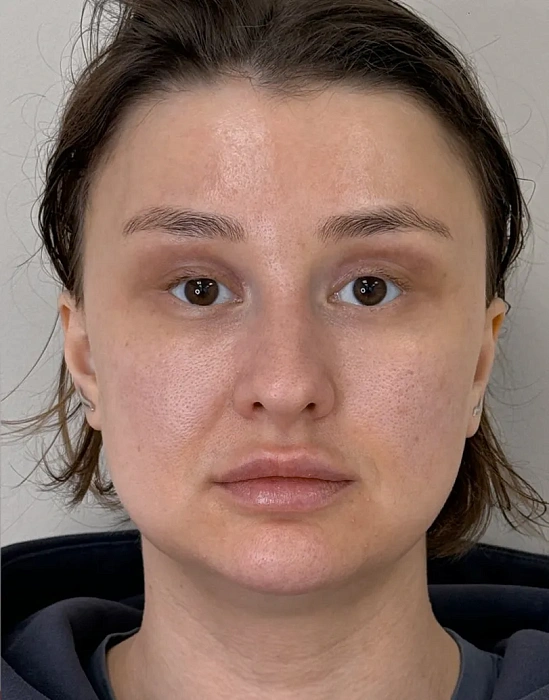 Блефаропластика
