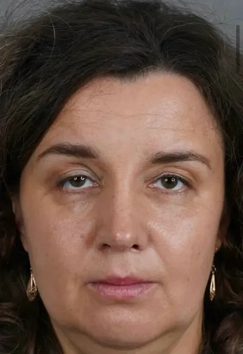 Rhinoplasty