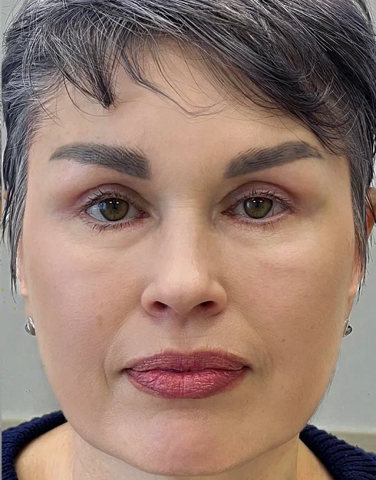 Верхняя блефаропластика