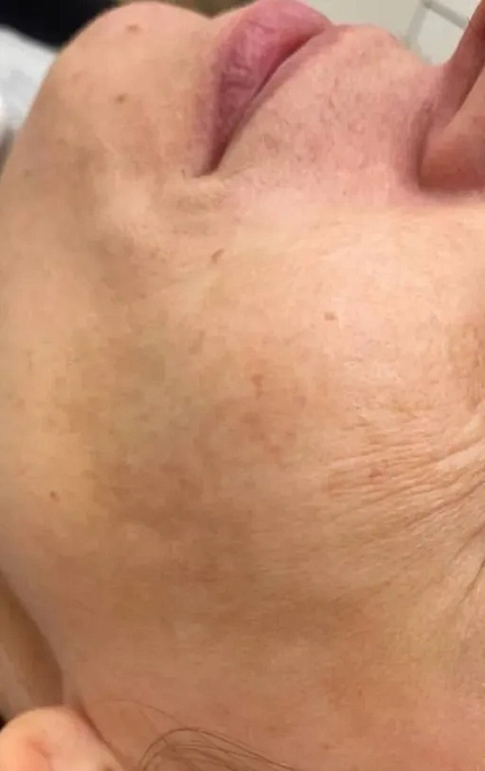 Peeling
