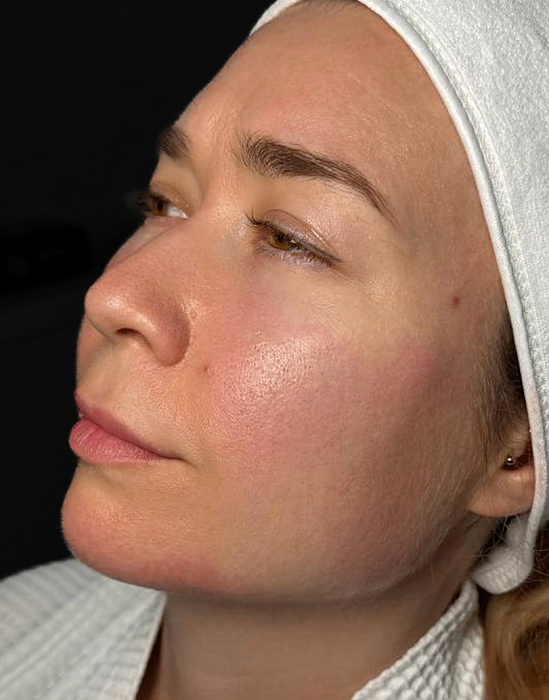 Контурная пластика лица филлером Radiesse, Контурная пластика