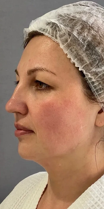 7D-rejuvenation Thermolifting Oligio