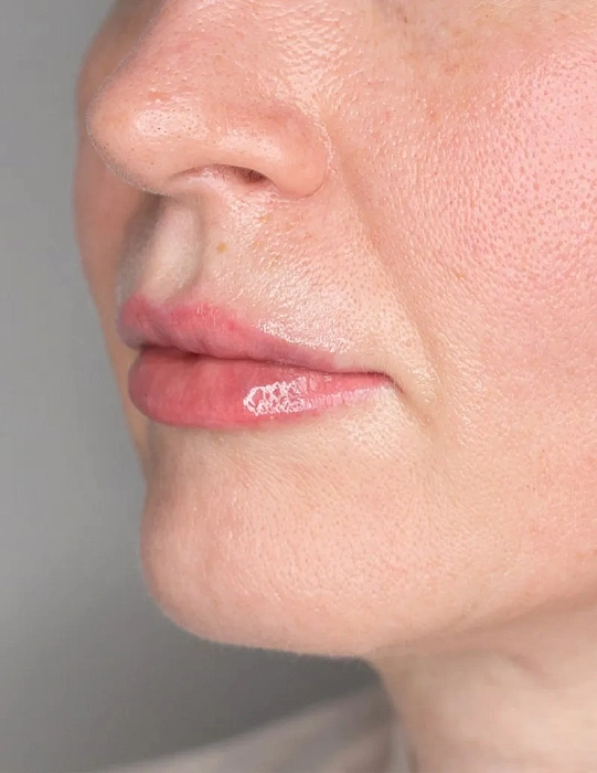 Contour plastic