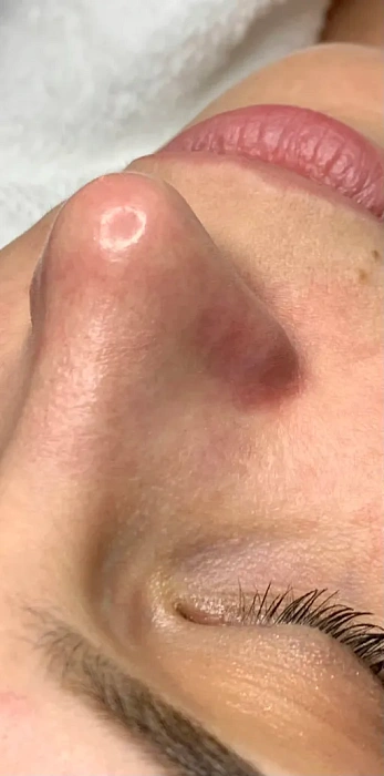 Очищение кожи Hydrafacial