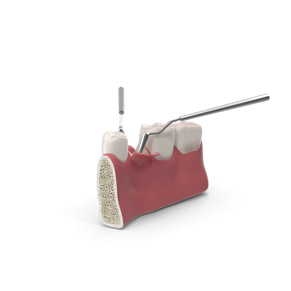 Atraumatic removal of wisdom teeth