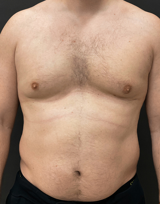 Лечение гинекомастии