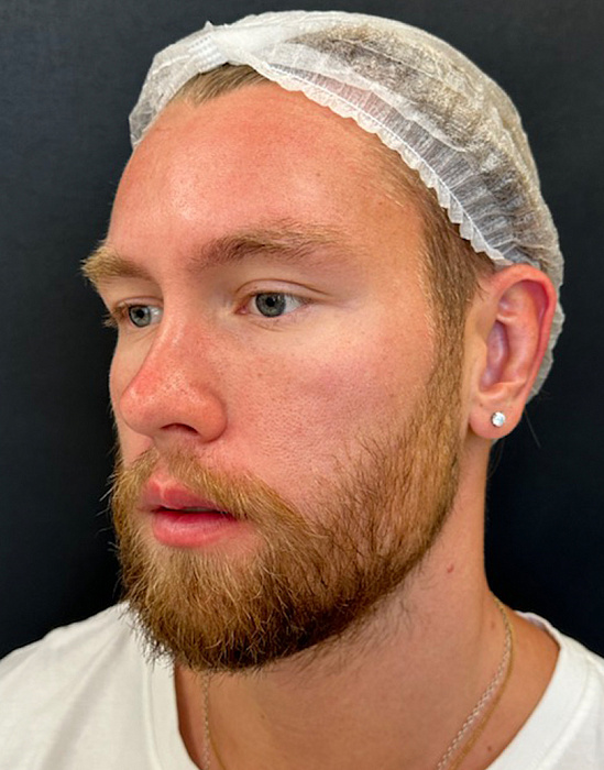 Otoplasty