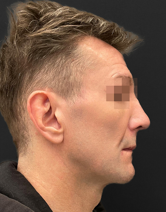 Rhinoplasty