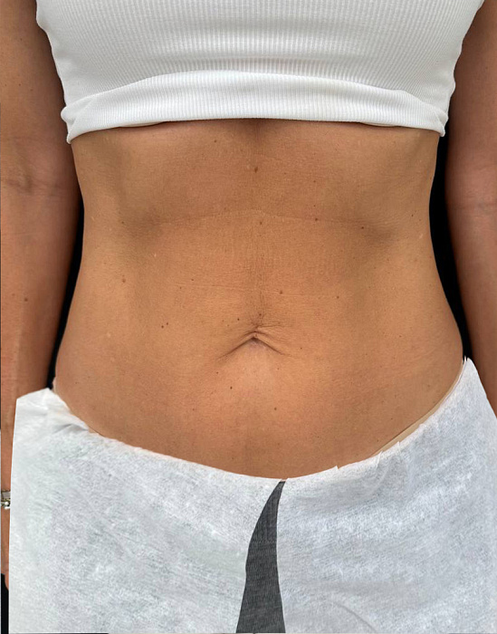 Коллагенотерапия, Игольчатый RF-лифтинг Morpheus 8