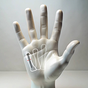 Treatment of metacarpal fractures