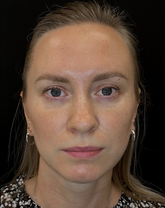 Blefaroplasty