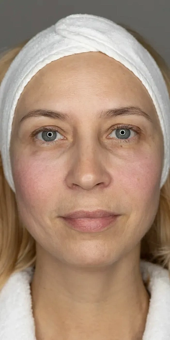 7D-rejuvenation Thermolifting Oligio
