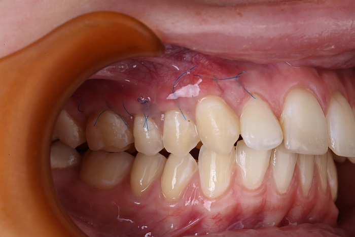 Закрытие рецессий