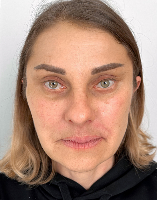 Эндоскопическая суспензия верхних двух третей лица с глубокой отслойкой DMAS