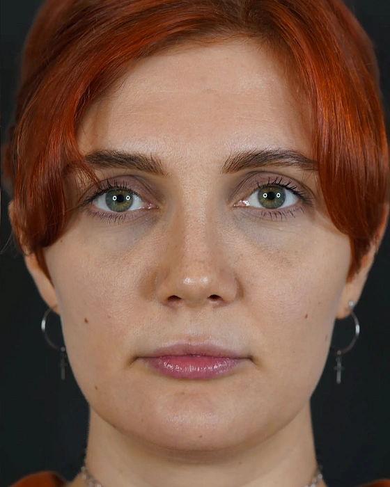 Ринопластика