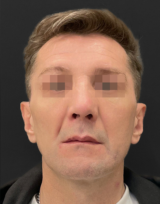 Ринопластика